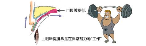 患了眼睑下垂，被称作上睑提肌的肌肉总是在非常努力地“工作”。