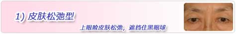 1)皮肤松弛型