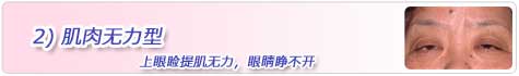 2)肌肉无力型