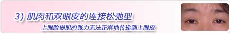 3)肌肉和双眼皮的连接松弛型
