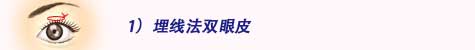 1.埋线法双眼皮