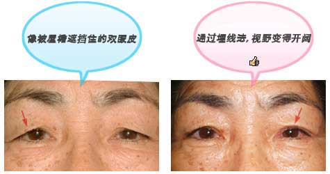 像被屋檐遮挡住的双眼皮 通过埋线法，视野变得开阔