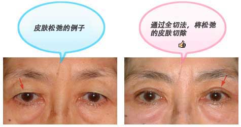 皮肤松弛的例子 通过全切法，将松弛的皮肤切除