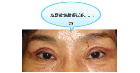 皮肤被切除得过多。。。