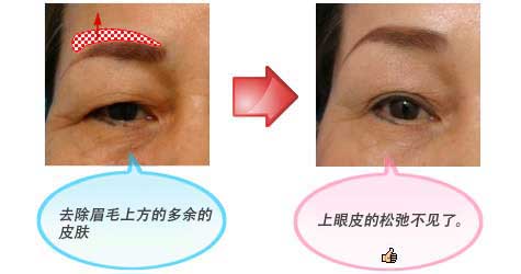 去除眉毛上方的多余的皮肤 上眼皮的松弛不见了。