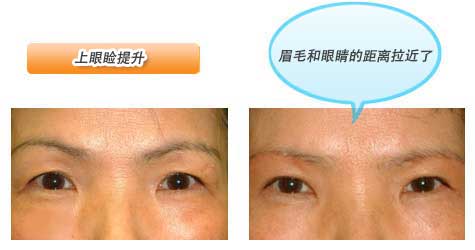 上眼睑提升 眉毛和眼睛的距离拉近了