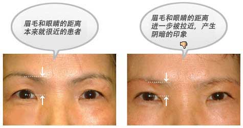 眉毛和眼睛的距离本来就很近的患者 眉毛和眼睛的距离进一步被拉近，产生阴暗的印象