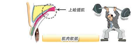 上睑提肌 肌肉软弱