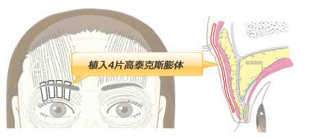 植入4片高泰克斯膨体