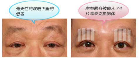 先天性的双眼下垂的患者