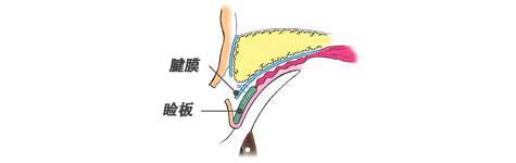 眼睑下垂：腱膜和睑板
