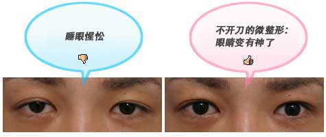 睡眼惺忪 不开刀的微整形：眼睛变有神了