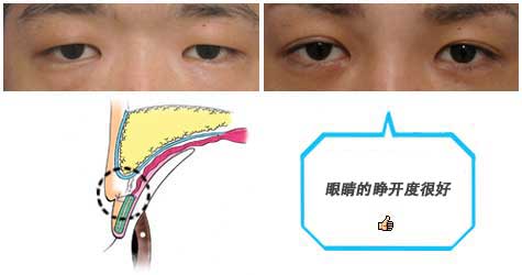 埋线法