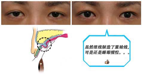 埋线法提肌