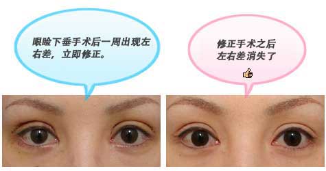 修正手术之后左右差消失了