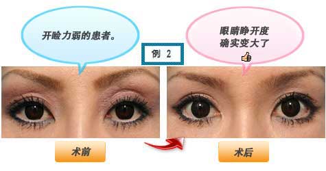 开睑力弱的患者。眼睛睁开度确实变大了