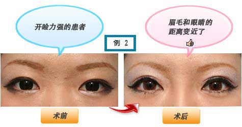 开睑力强的患者 眉毛和眼睛的距离变近了