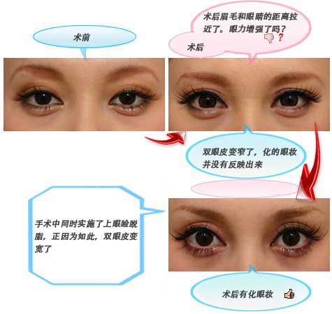 手术中同时实施了上眼睑脱脂，正因为如此，双眼皮变宽了