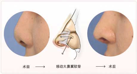 大鼻翼软骨向下方和前方移动