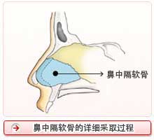 鼻中隔软骨