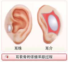 耳软骨