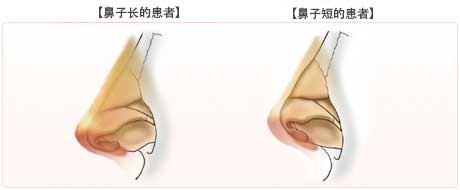 鼻子长的患者,鼻子短的患者