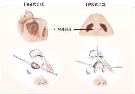 闭合式切口,开放式切口1