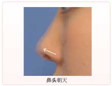 鼻头朝天(上前方延长)