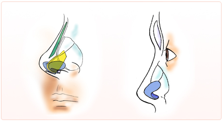 隆鼻术,眉间形成术