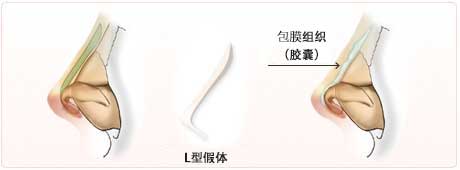 假体周围形成的包膜组织