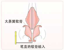 笔直的软骨植入