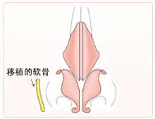 弯曲的软骨