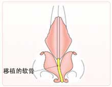 鼻变形