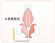 笔直的软骨植入