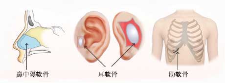 鼻中隔延长术使用的软骨