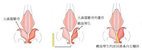 鼻中隔延長術 変形問題イラスト1-a