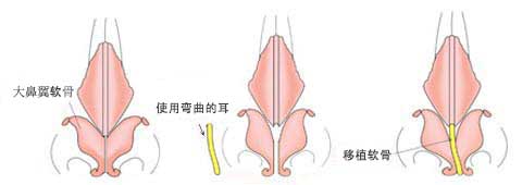 因此我们把这个变形的耳软骨取出来，使用鼻中隔软骨做了鼻中隔延长术。