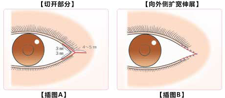 外眼角切开