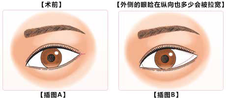 目尻切開の術式