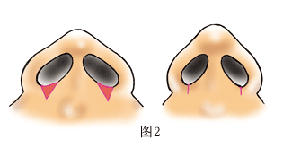 鼻翼缩小 内侧切除