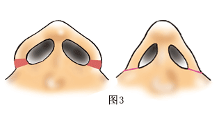 工匠的技术 鼻翼缩小（初级篇）