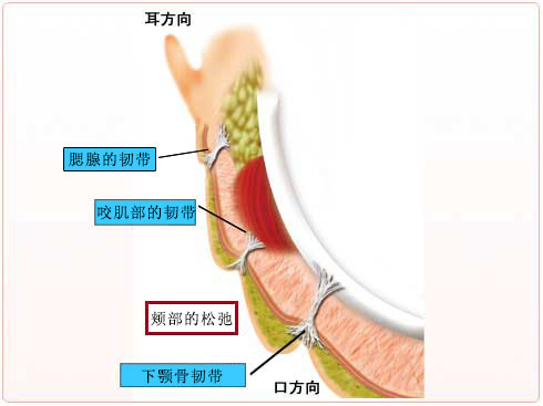 面部提升术