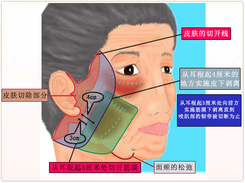为了提高提升効果