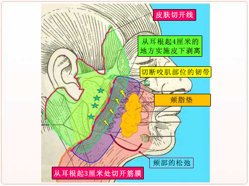 颊脂垫的处理
