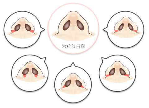 工匠的技术 鼻翼缩小（高级篇）