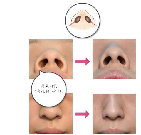 鼻翼的内侧（鼻孔的下外侧）