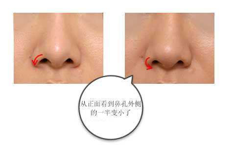 正是这个原因，从正面看，鼻孔的外侧有一半变小了。